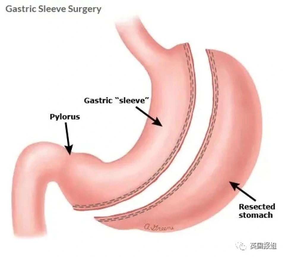 切胃手术的三种类型